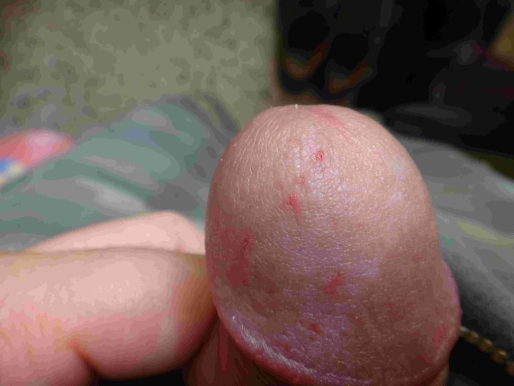 Red spot on glans penis