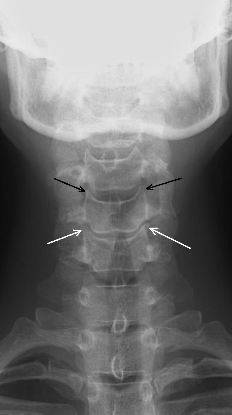 joint cervical spine hypertrophy Uncovertebral