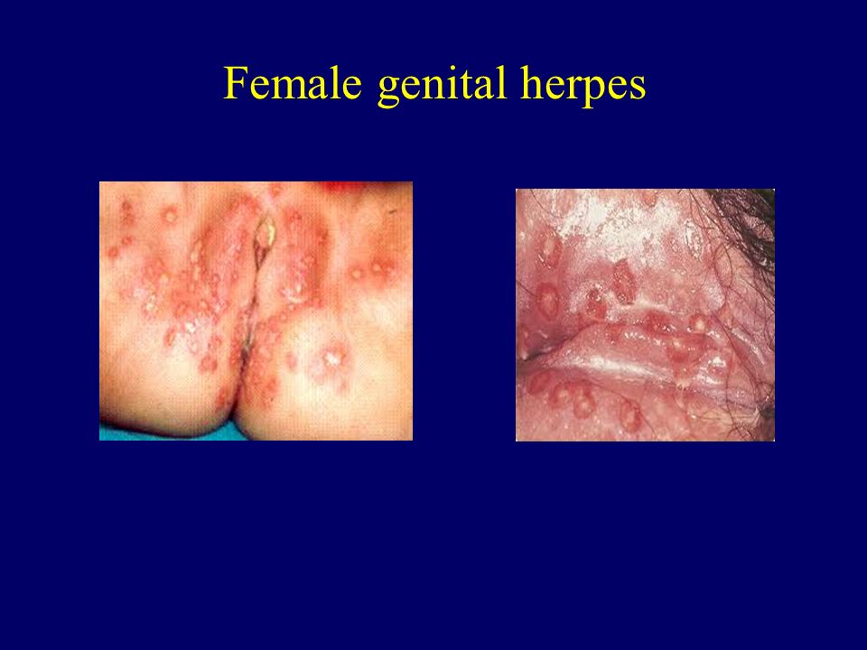 in women herpes Genital
