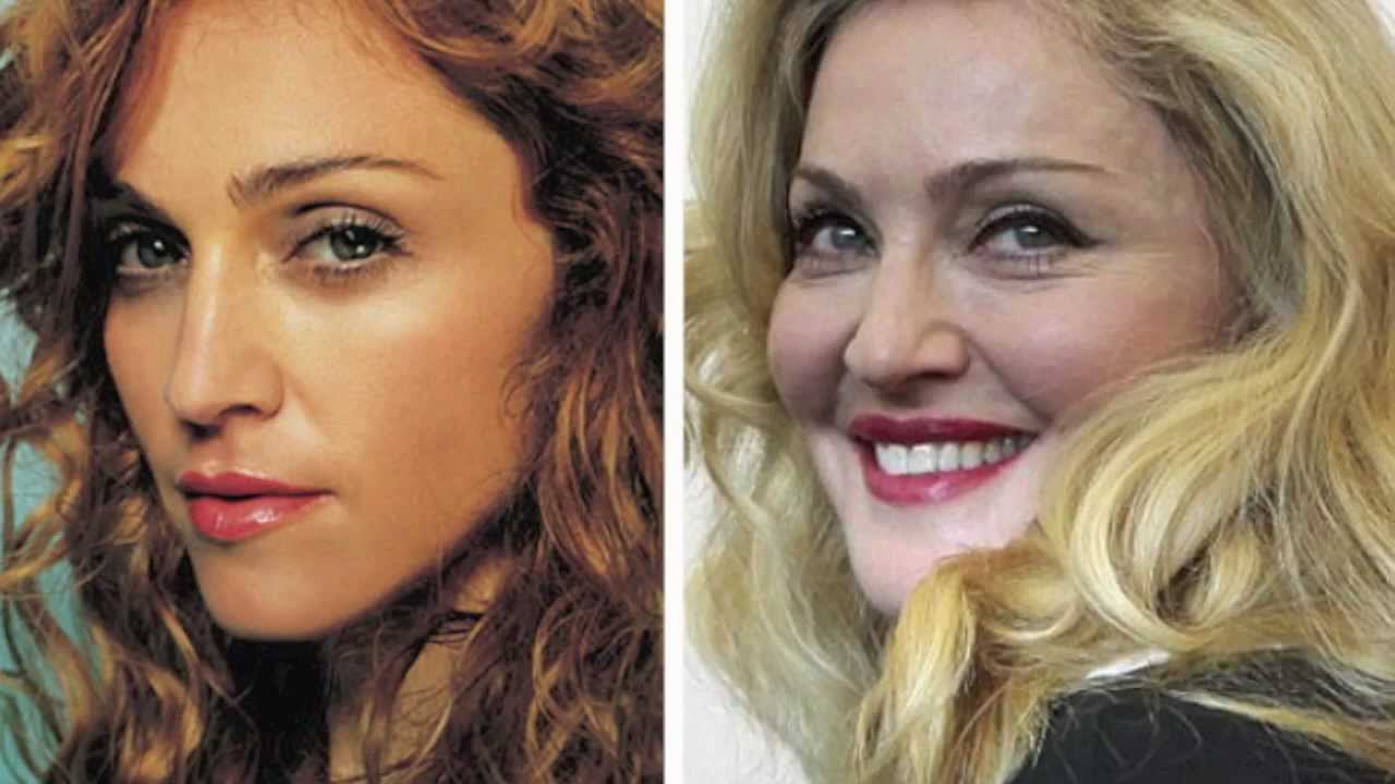 Madonna plastic surgery