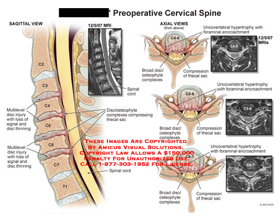 Uncovertebral joint hypertrophy cervical spine