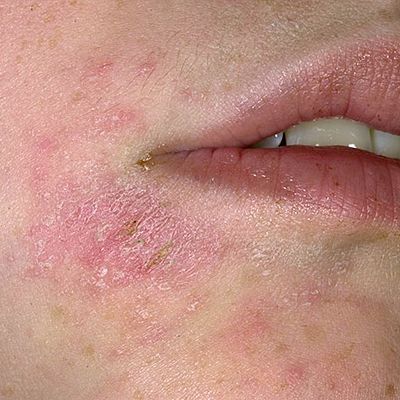 itchy rash on face Red