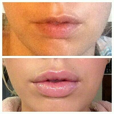Collagen lips amateur